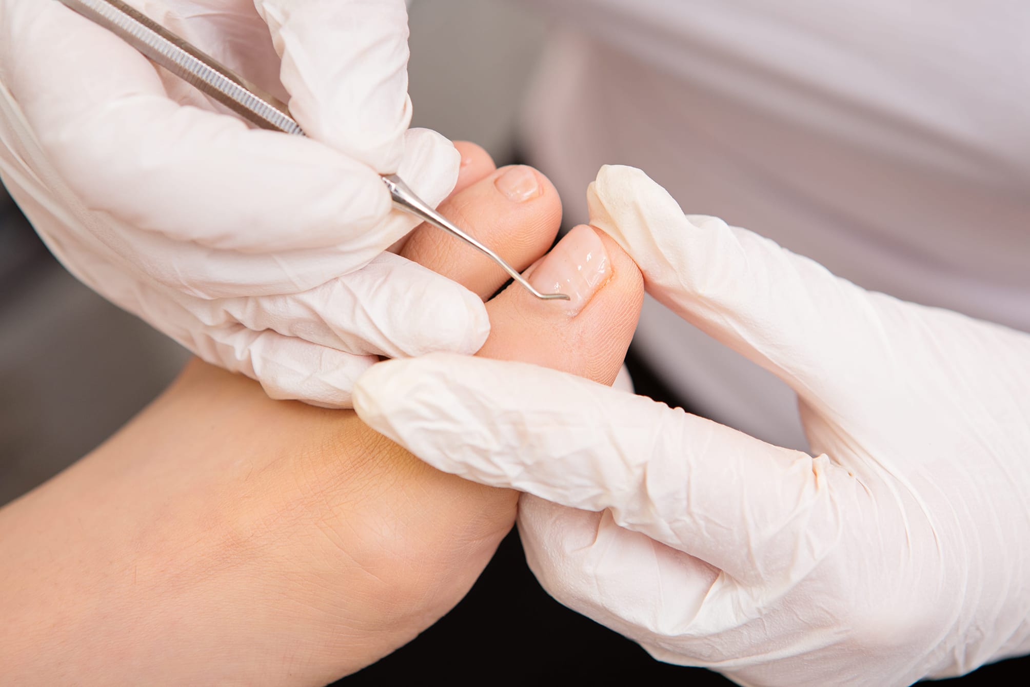 person with white gloves doing podiatry on foot